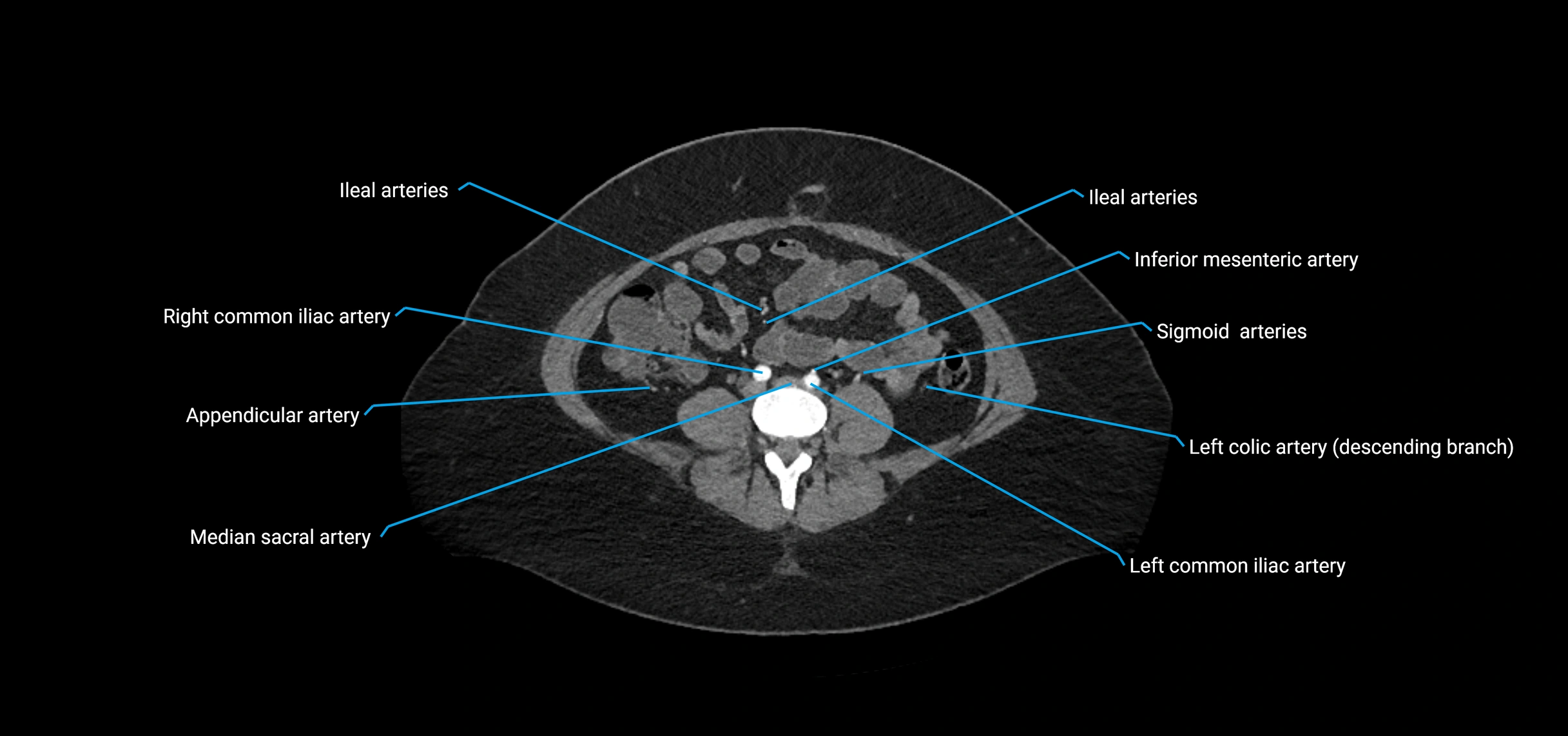 CTA abdomen axial cross sectional anatomy labelled image_148 (2).webp